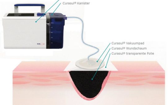 Entwicklung der Curasul Therapieeinheit für die Unterdruck-Wundversorgung