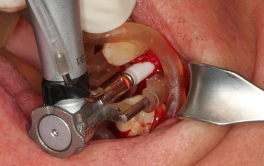 Das hülsenlos geführte keramische Implantat