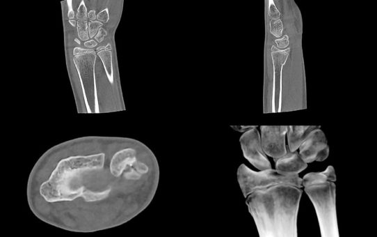 Perspektive DVT- Anwendung der digitalen Volumentomographie in der kindlichen Extremitätendiagnostik