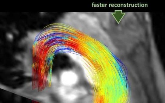 Künstliche Intelligenz beschleunigt MRI des Blutflusses