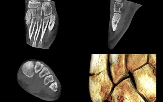 Perspektive DVT – Anwendung der DVT in der sportmedizinischen Extremitätendiagnostik