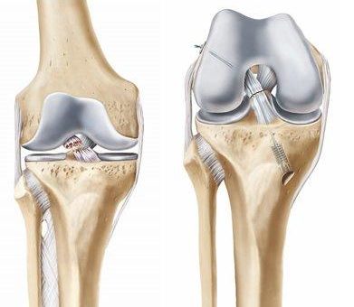 Diagnose Kreuzbandriss: Das körpereigene Kreuzband behalten