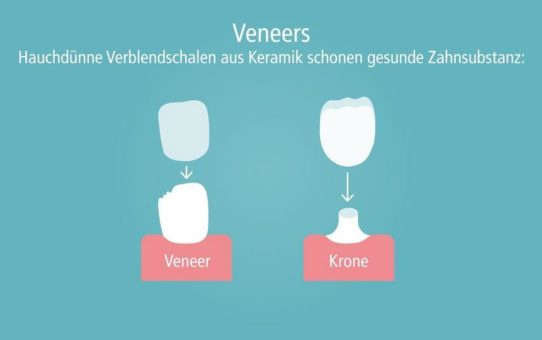 Zahn-Veneers: Wann sind sie sinnvoll?