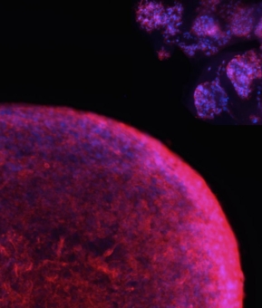 Blutstammzellen machen Hirntumoren aggressiver