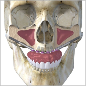 Straumann Zygomatisches Implantatsystem