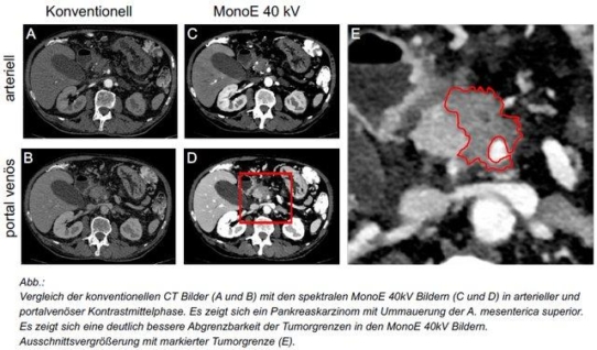 Dual-Layer Spektral-CT: Bessere Therapieplanung beim Bauchspeicheldrüsenkrebs