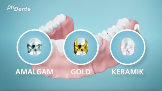 Erklärvideo für Patienten: Welche Zahnfüllungen gibt es?