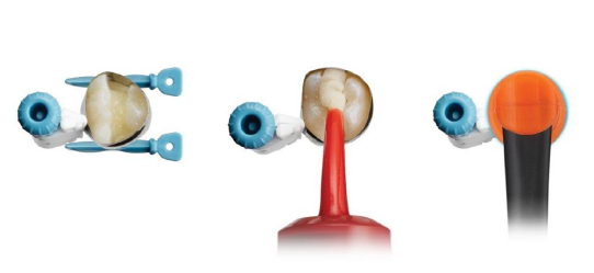 Dentsply Sirona: Langlebige Restaurationen, zahnfarben und ganz ohne Bonding - eine echte Alternative zu Kompositen in schwierigen Situationen