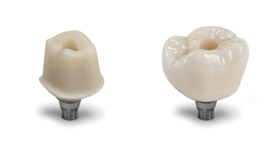 CEREC Tessera: Jetzt auch für Hybrid-Abutmentkronen im Chairside-Workflow verfügbar