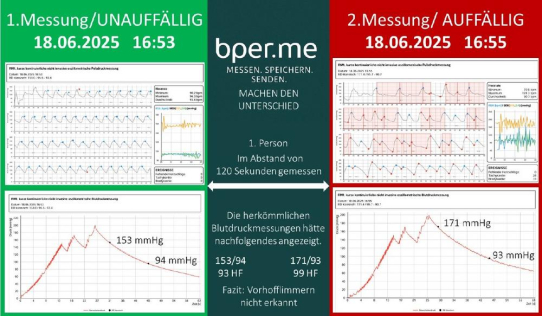Blutdruckschwankungen 2. Ordnung entschlüsselt – bper.me präsentiert BDII-Kalibrierung für präzise Wearable-Messungen