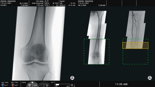 ECR 2026: Ziehm Imaging präsentiert neue OP-Tisch-Steuerung und innovative endovaskuläre Softwarelösung