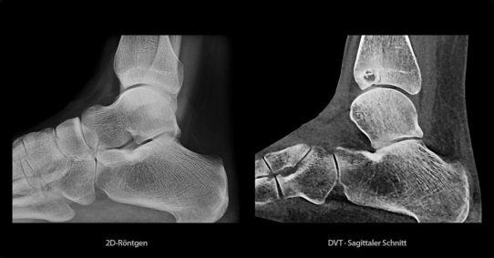 Bänderriss am Sprunggelenk: Diagnostische 3D-Präzision mit der DVT Bildgebung